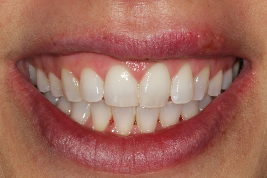 whitening_mallorca_4_despues