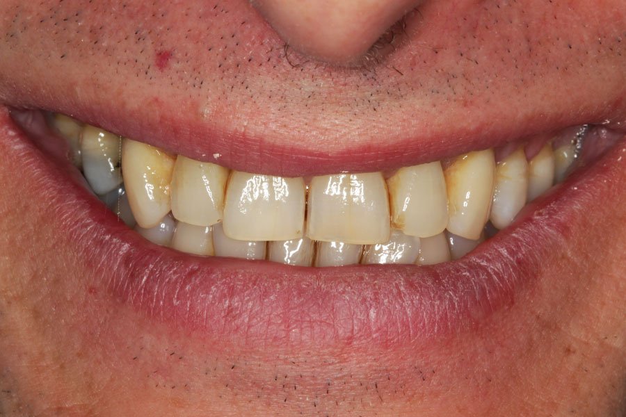 whitening_mallorca_5_antes