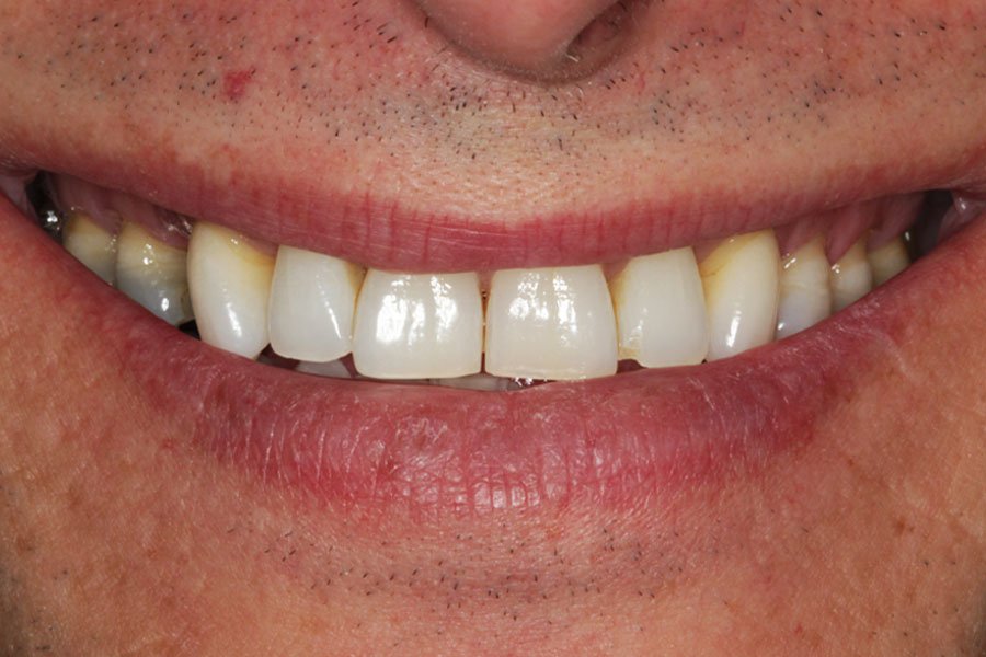 whitening_mallorca_5_despues