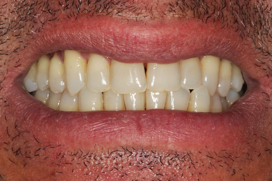 whitening_mallorca_6_antes