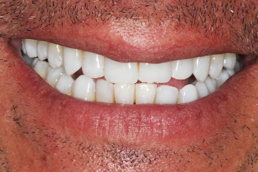whitening_mallorca_6_despues