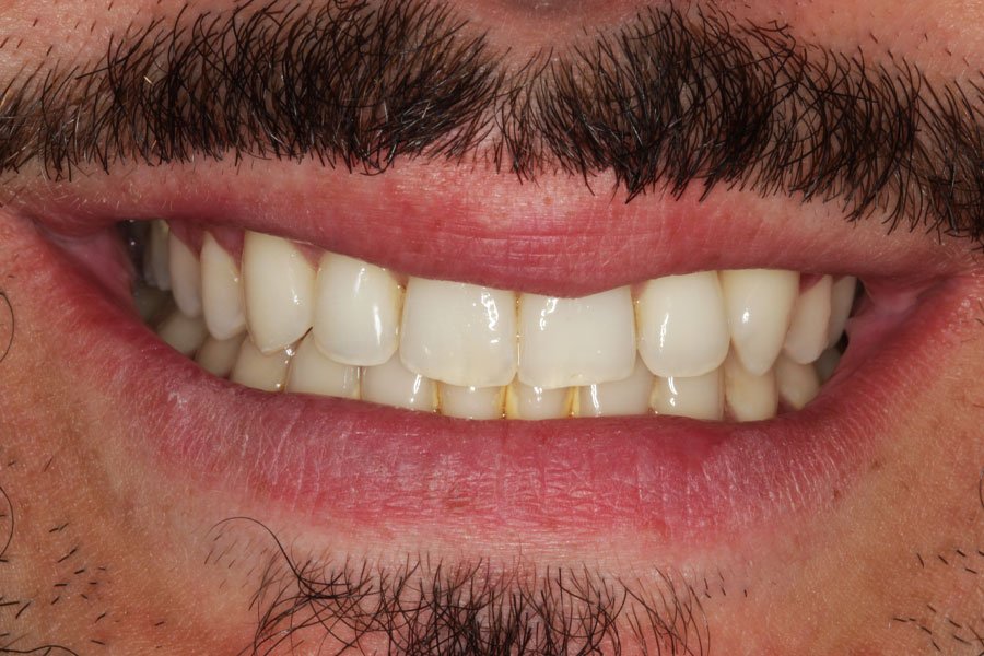 whitening_mallorca_7_antes