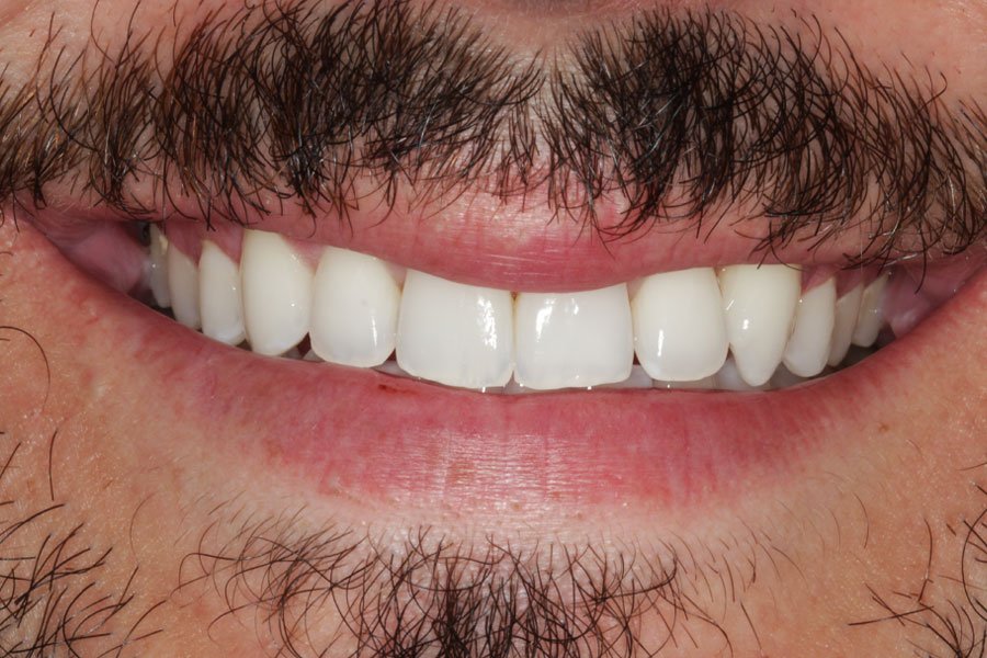 whitening_mallorca_7_despues
