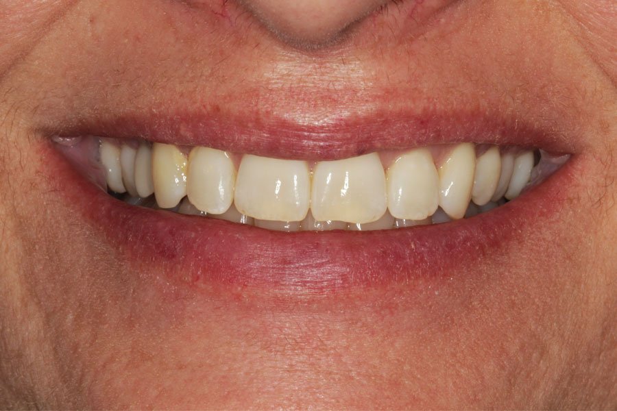 whitening_mallorca_8_antes