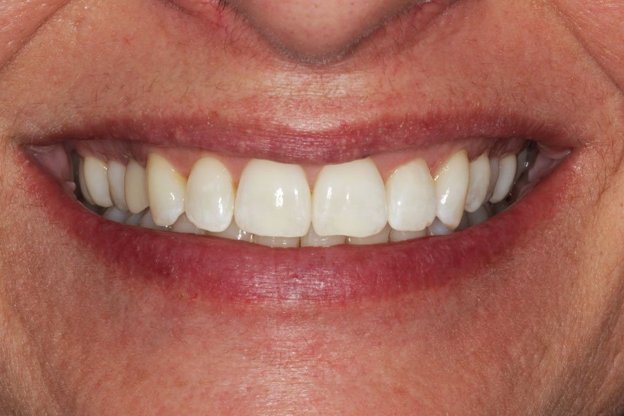 whitening_mallorca_8_despues