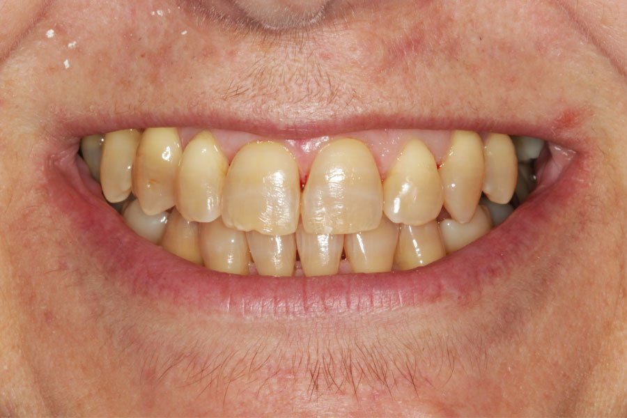 whitening_mallorca_9_antes