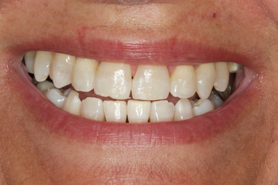 whitening_mallorca_9_despues
