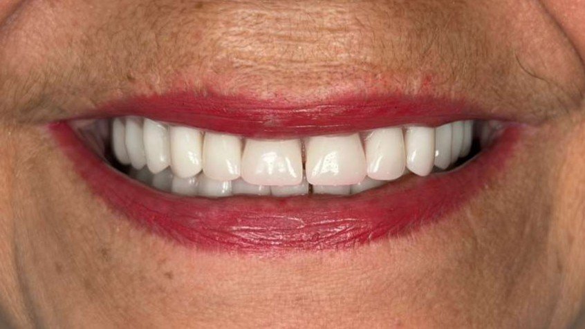 denture_after_1