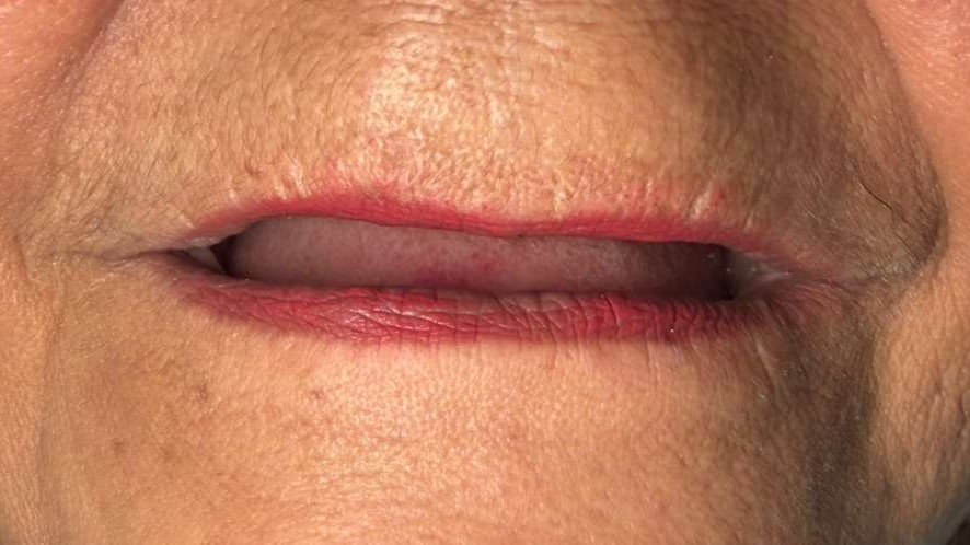 denture_before_1 denture_before_1